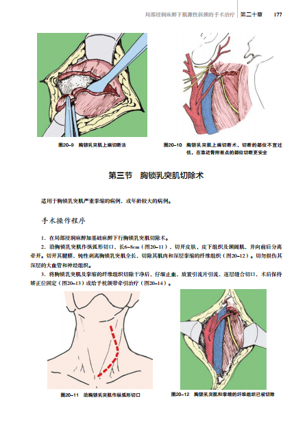 胸锁乳突肌切断术图片